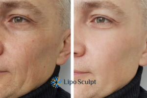 How to Fight Aging Symptoms 3 Fight Aging Symptoms Whitley Bay With HIFU and Morpheus8 Today!