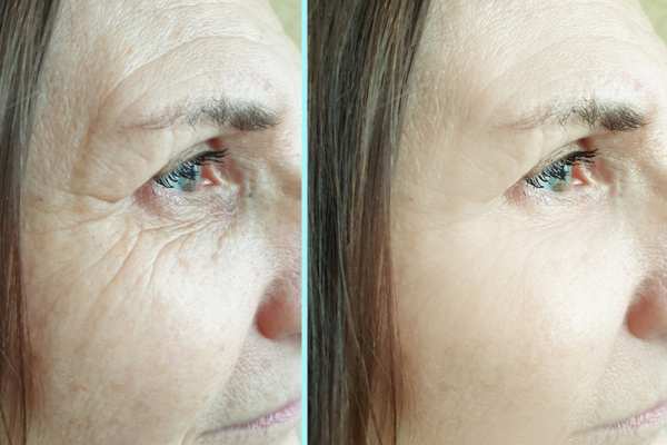 Why Do People Choose HIFU for a Non-Surgical Facelift? 4 How long can HIFU results last Whitley Bay?