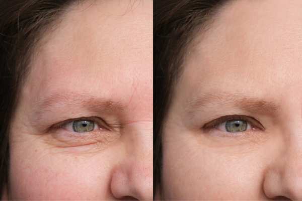 HIFU vs Botulinum Toxin: Understanding the Differences 4 How long do HIFU results last Whitley Bay?