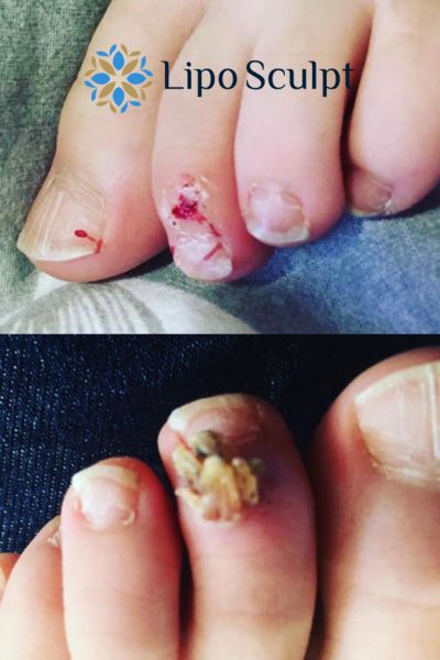 Wart removal customer results from Lipo Sculpt Whitley Bay