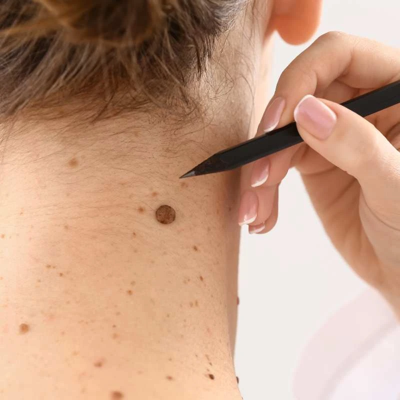 How to Support Your Body During Pregnancy for Faster Postnatal Recovery 5 See our lesion removal prices Whitley Bay - call today for a free quote